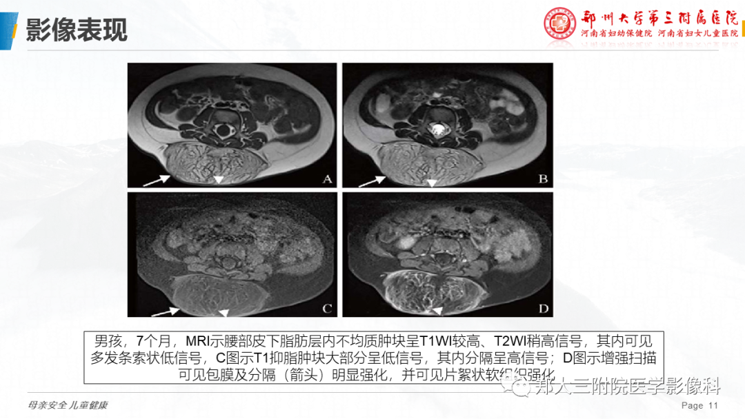 影像PPT - 【PPT】脂肪母细胞瘤的影像诊断-11