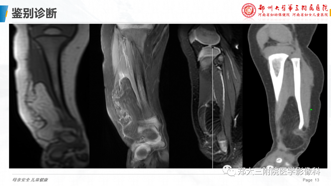 影像PPT - 【PPT】脂肪母细胞瘤的影像诊断-13