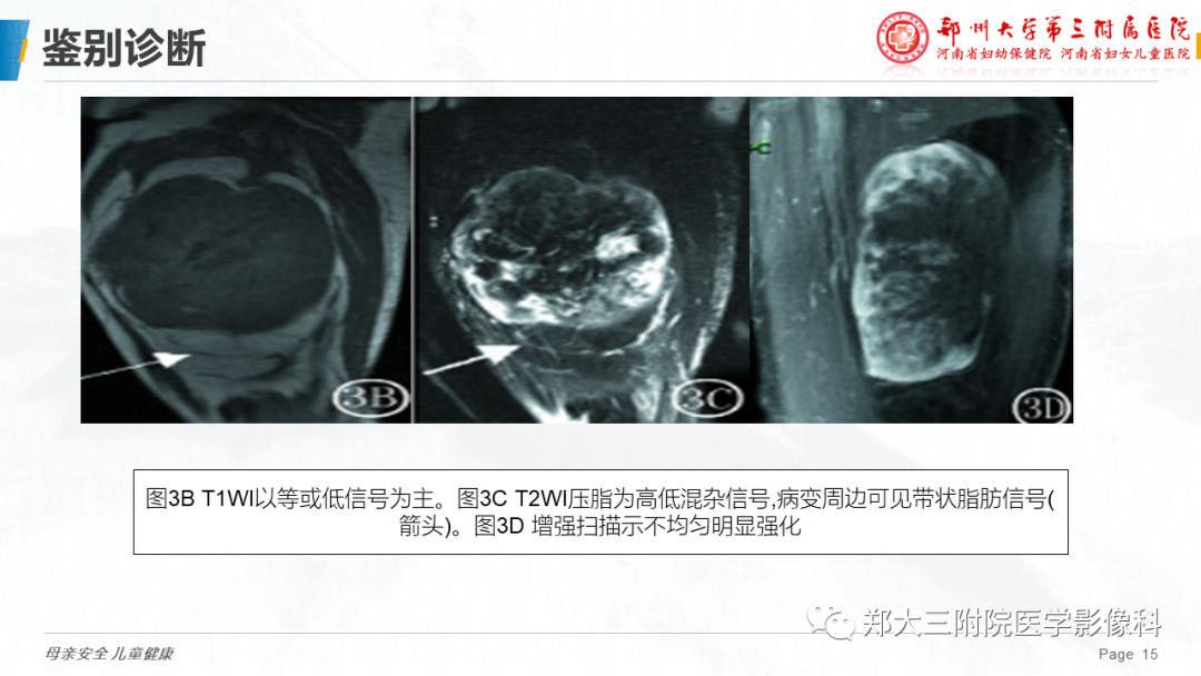 影像PPT - 【PPT】脂肪母细胞瘤的影像诊断-15