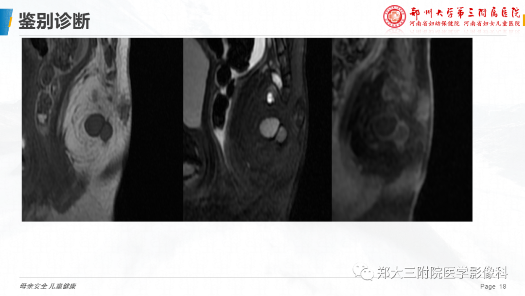影像PPT - 【PPT】脂肪母细胞瘤的影像诊断-18