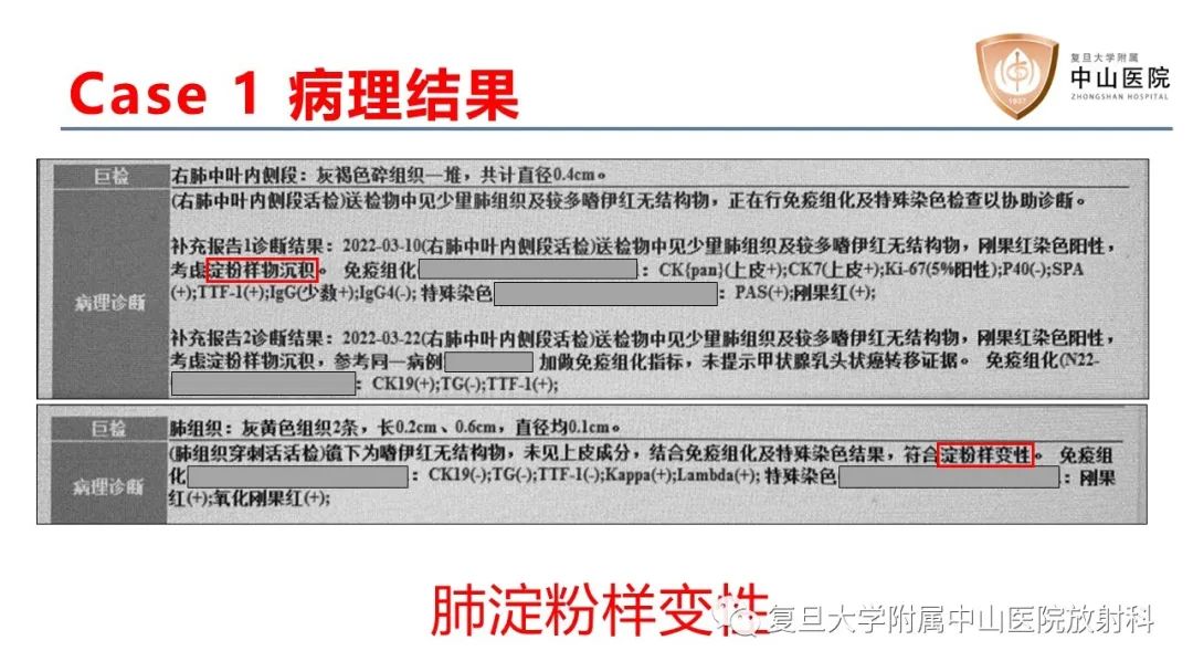 影像PPT - 【病例】肺淀粉样变性2例CT影像-7