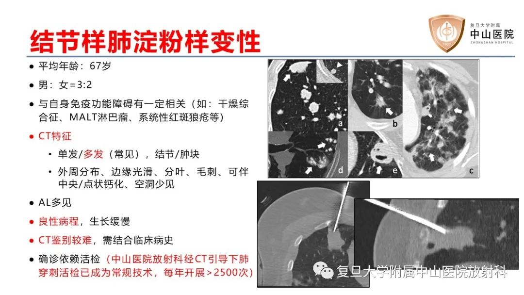 影像PPT - 【病例】肺淀粉样变性2例CT影像-13
