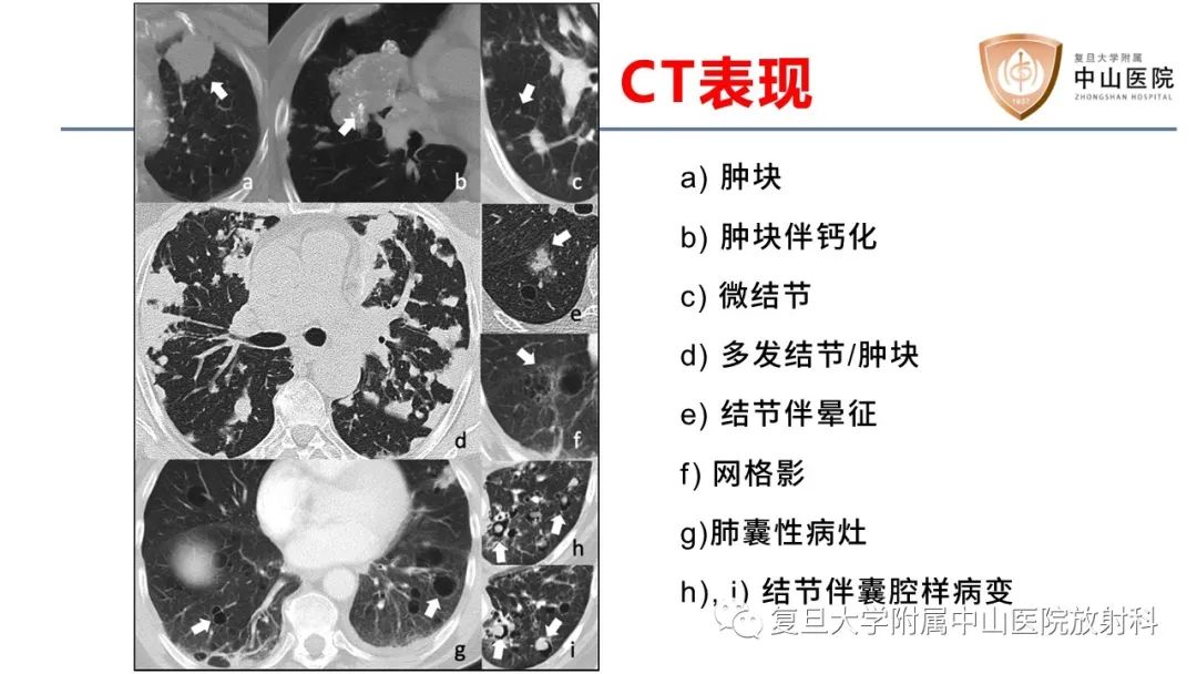 影像PPT - 【病例】肺淀粉样变性2例CT影像-14