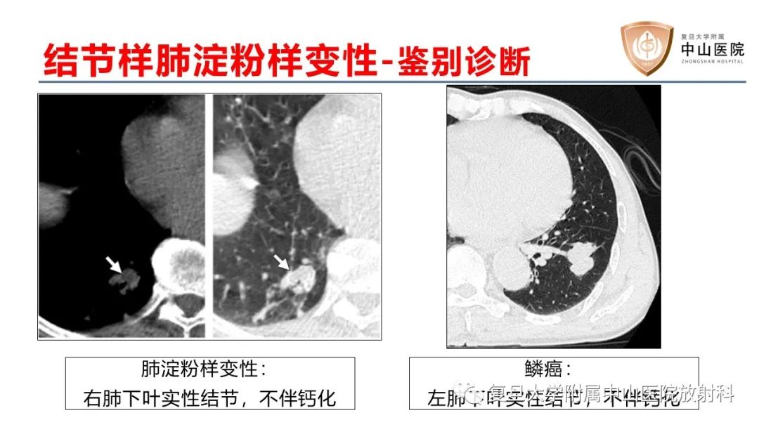影像PPT - 【病例】肺淀粉样变性2例CT影像-15