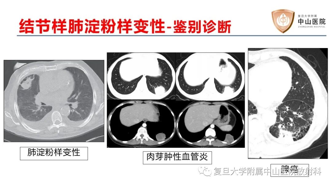 影像PPT - 【病例】肺淀粉样变性2例CT影像-16