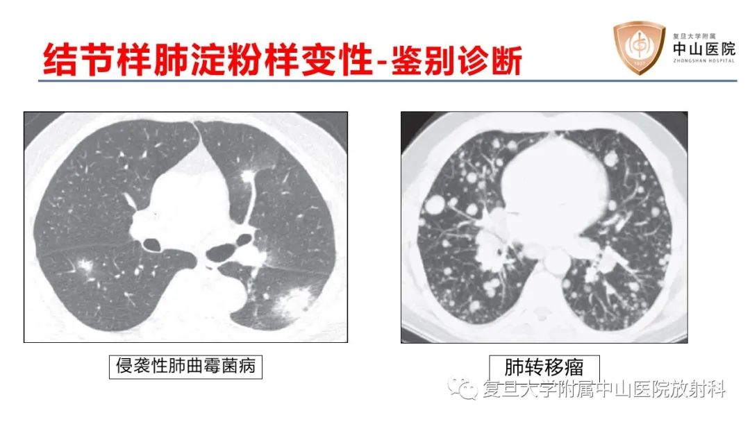 影像PPT - 【病例】肺淀粉样变性2例CT影像-17