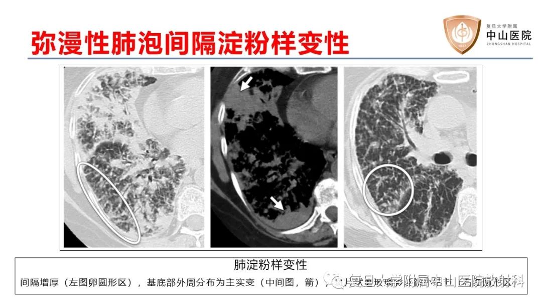 影像PPT - 【病例】肺淀粉样变性2例CT影像-19