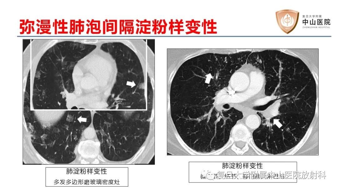 影像PPT - 【病例】肺淀粉样变性2例CT影像-20