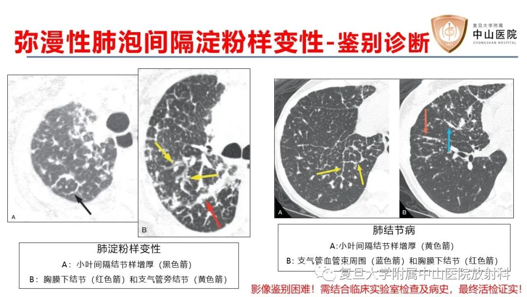 影像PPT - 【病例】肺淀粉样变性2例CT影像-21