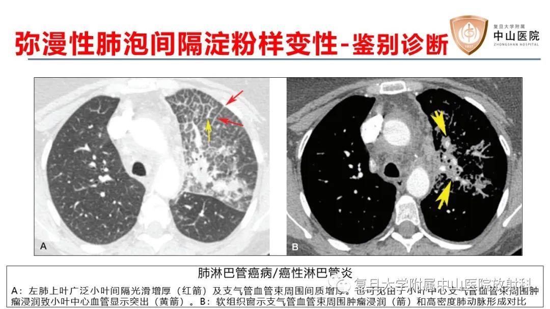 影像PPT - 【病例】肺淀粉样变性2例CT影像-22