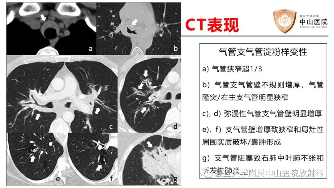 影像PPT - 【病例】肺淀粉样变性2例CT影像-24