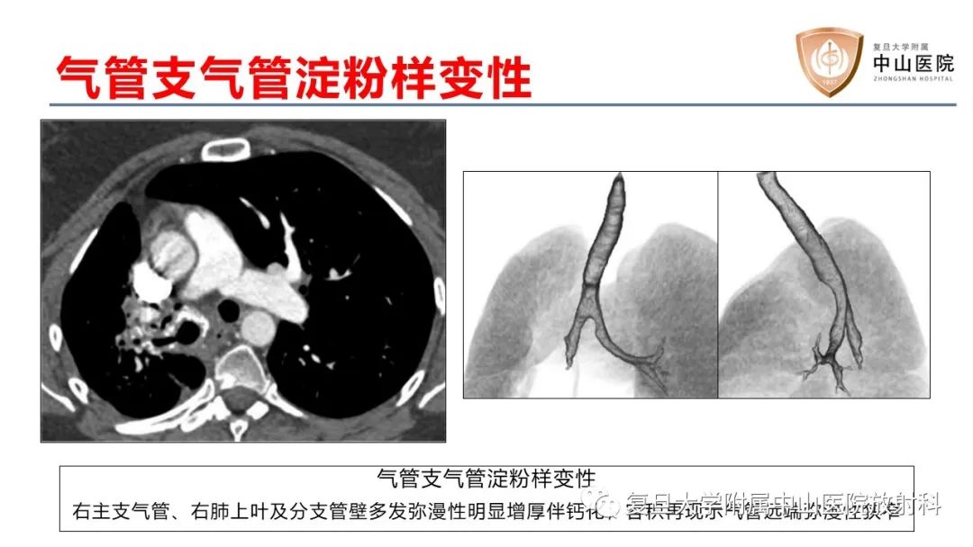 影像PPT - 【病例】肺淀粉样变性2例CT影像-25