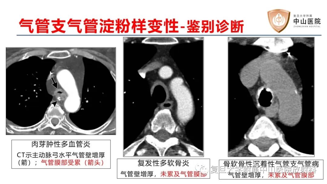 影像PPT - 【病例】肺淀粉样变性2例CT影像-26