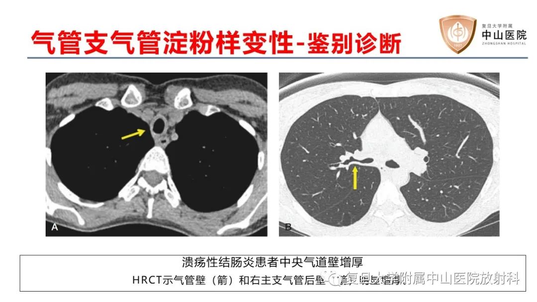 影像PPT - 【病例】肺淀粉样变性2例CT影像-27