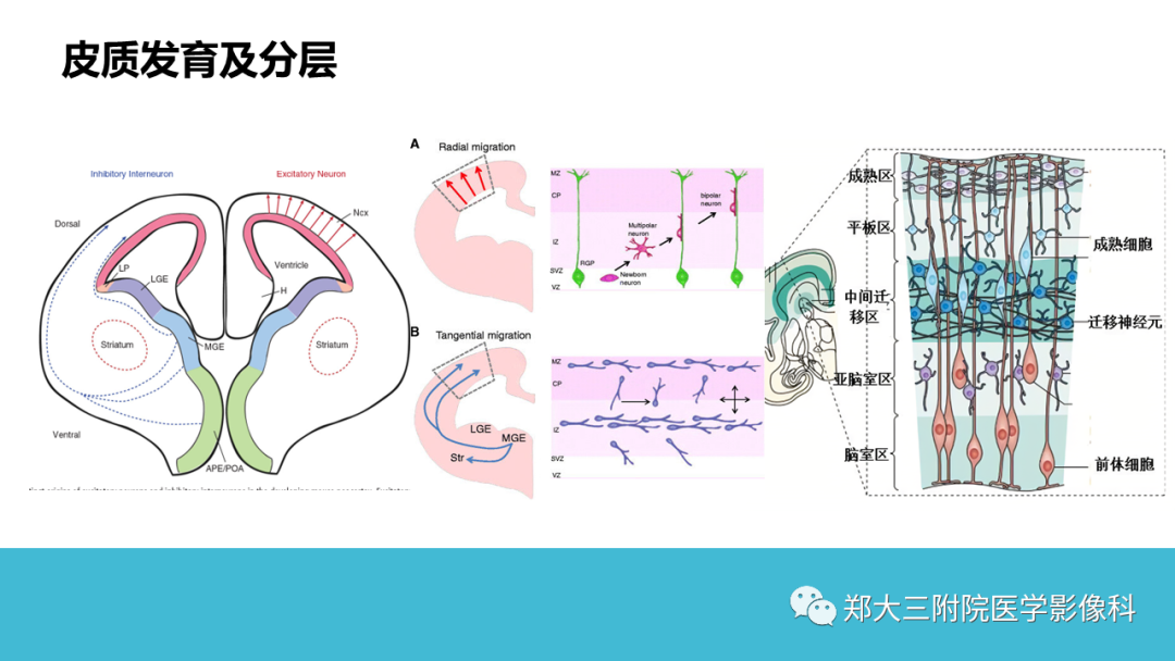 影像PPT - 【PPT】儿童皮层发育畸形影像诊断-7