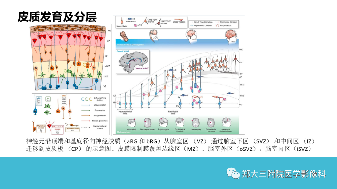 影像PPT - 【PPT】儿童皮层发育畸形影像诊断-8