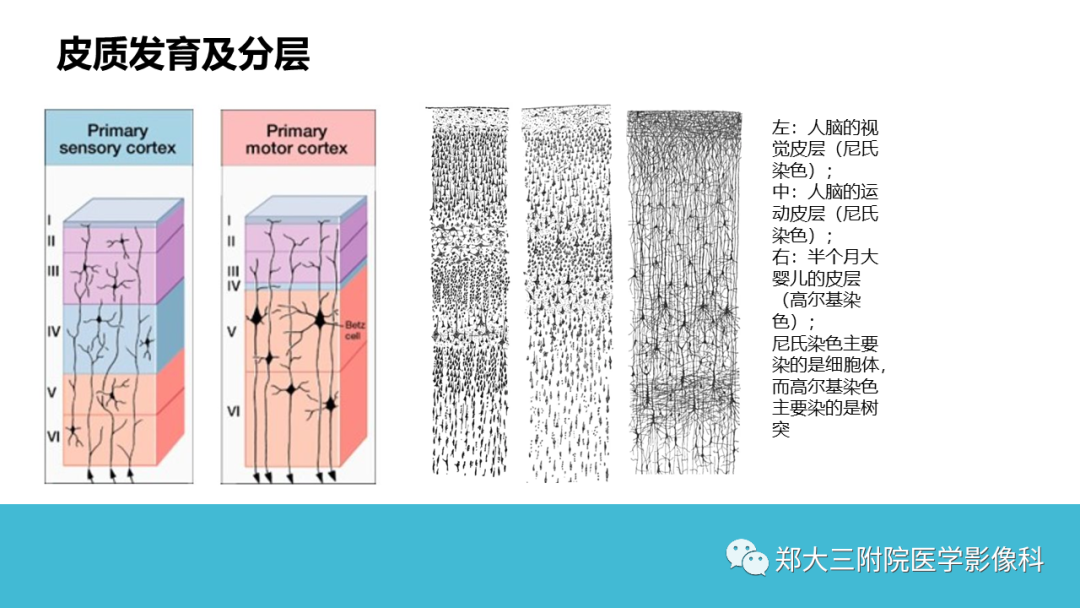影像PPT - 【PPT】儿童皮层发育畸形影像诊断-10