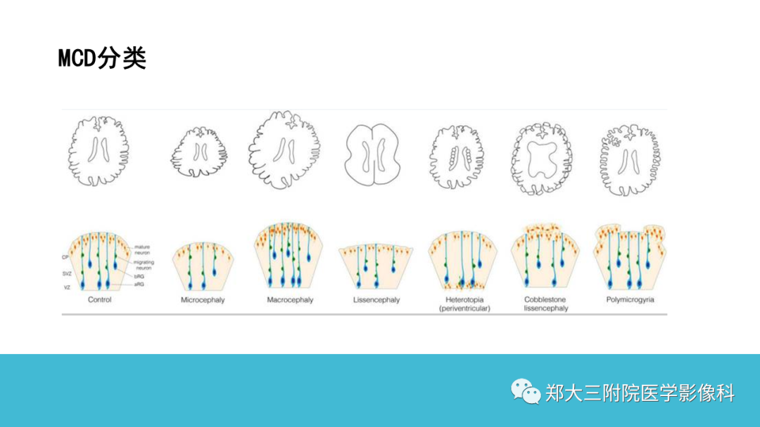 影像PPT - 【PPT】儿童皮层发育畸形影像诊断-15