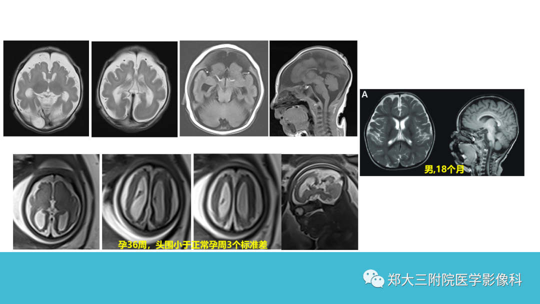 影像PPT - 【PPT】儿童皮层发育畸形影像诊断-17