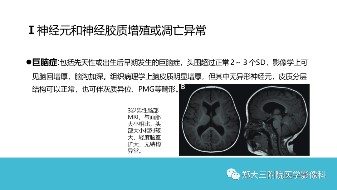 影像PPT - 【PPT】儿童皮层发育畸形影像诊断-18