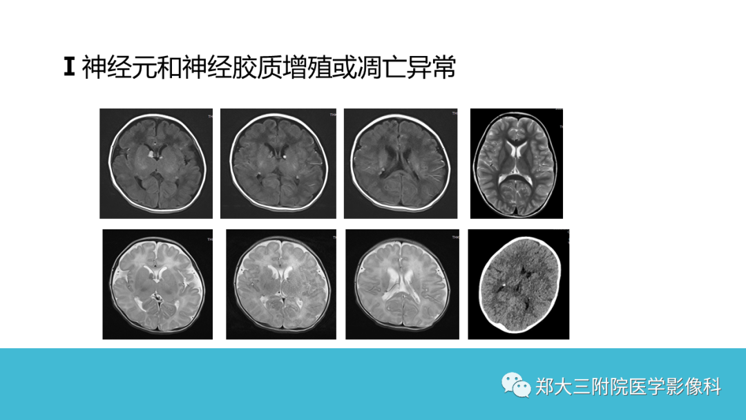 影像PPT - 【PPT】儿童皮层发育畸形影像诊断-25