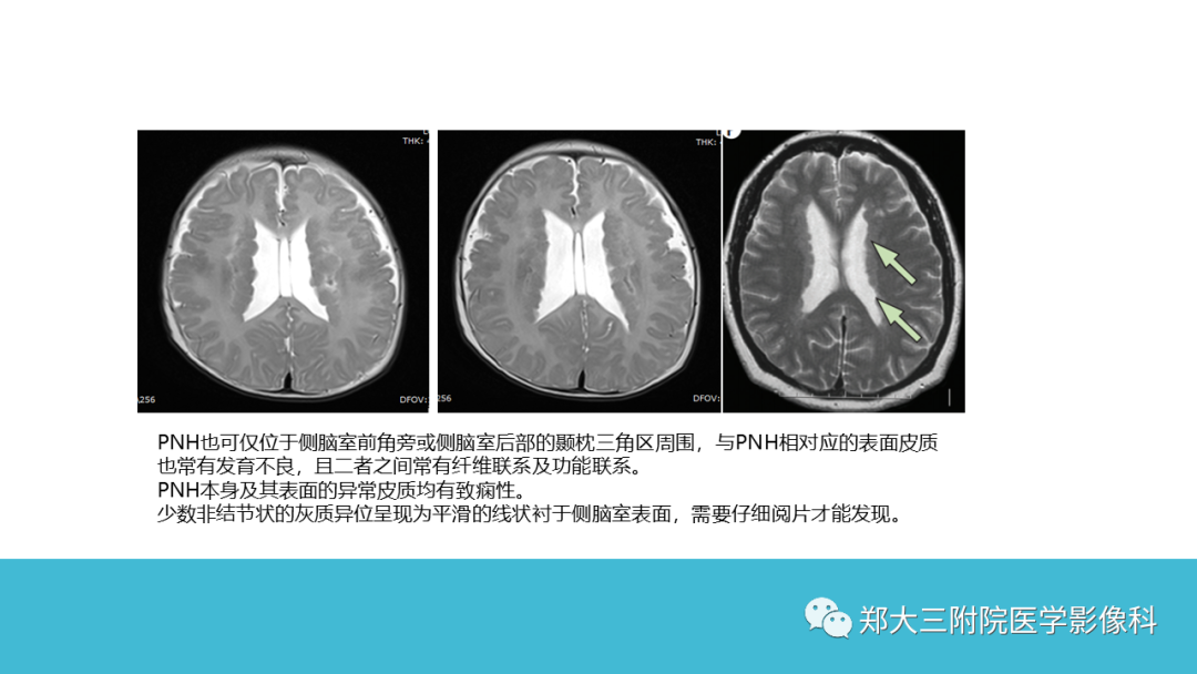 影像PPT - 【PPT】儿童皮层发育畸形影像诊断-30