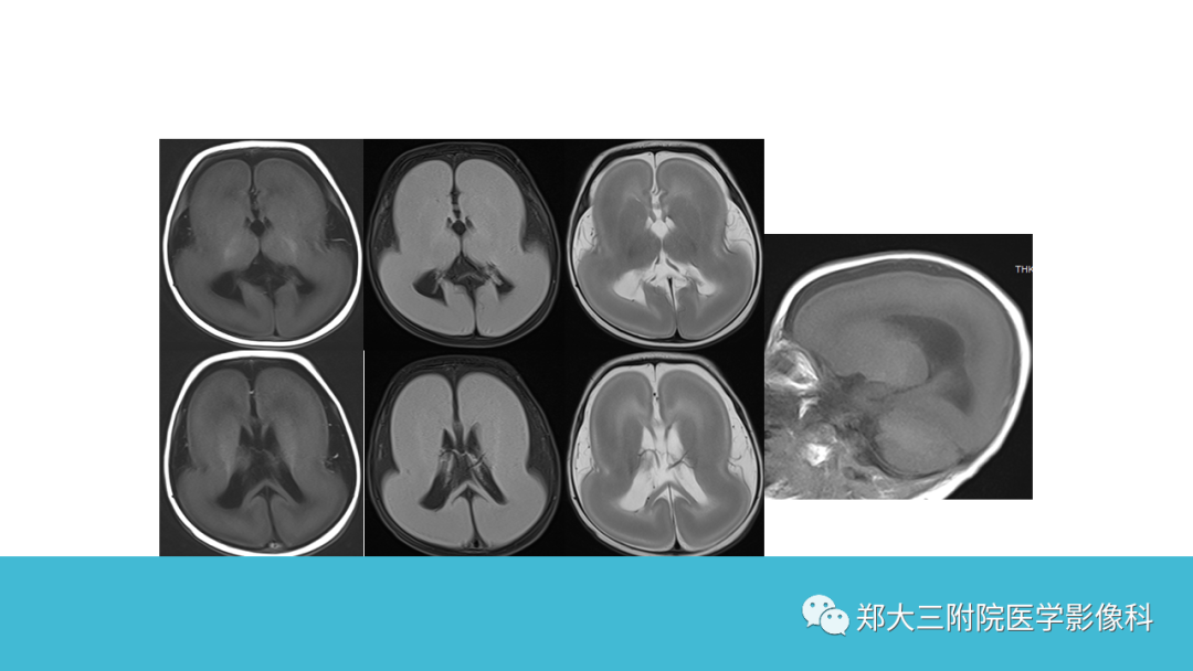影像PPT - 【PPT】儿童皮层发育畸形影像诊断-32