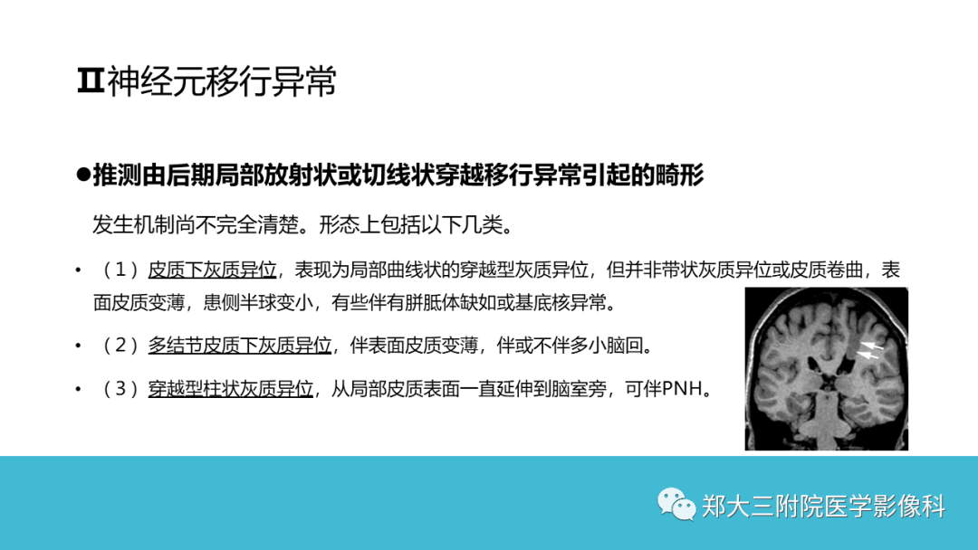 影像PPT - 【PPT】儿童皮层发育畸形影像诊断-33