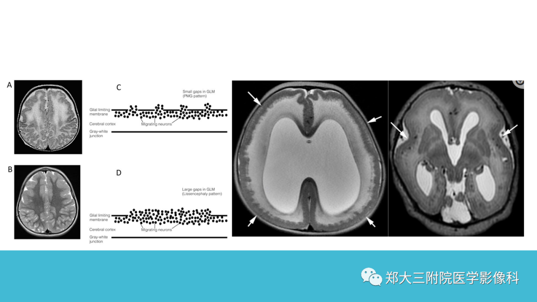 影像PPT - 【PPT】儿童皮层发育畸形影像诊断-35