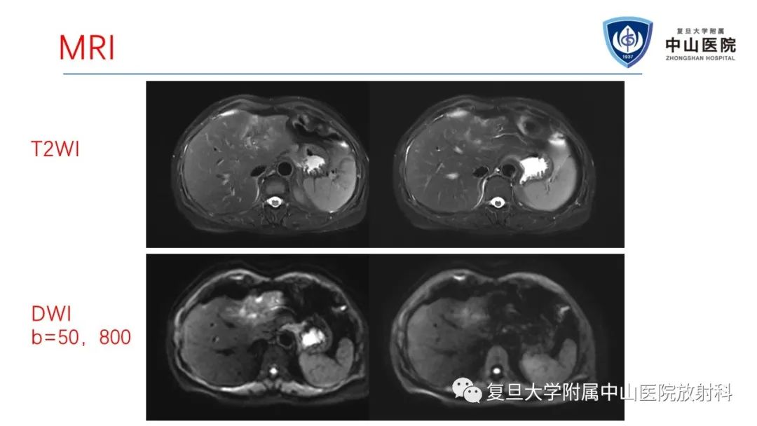 影像PPT - 【病例】肝节段性萎缩1例CT及MR影像-4