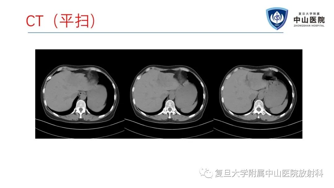 影像PPT - 【病例】肝节段性萎缩1例CT及MR影像-3