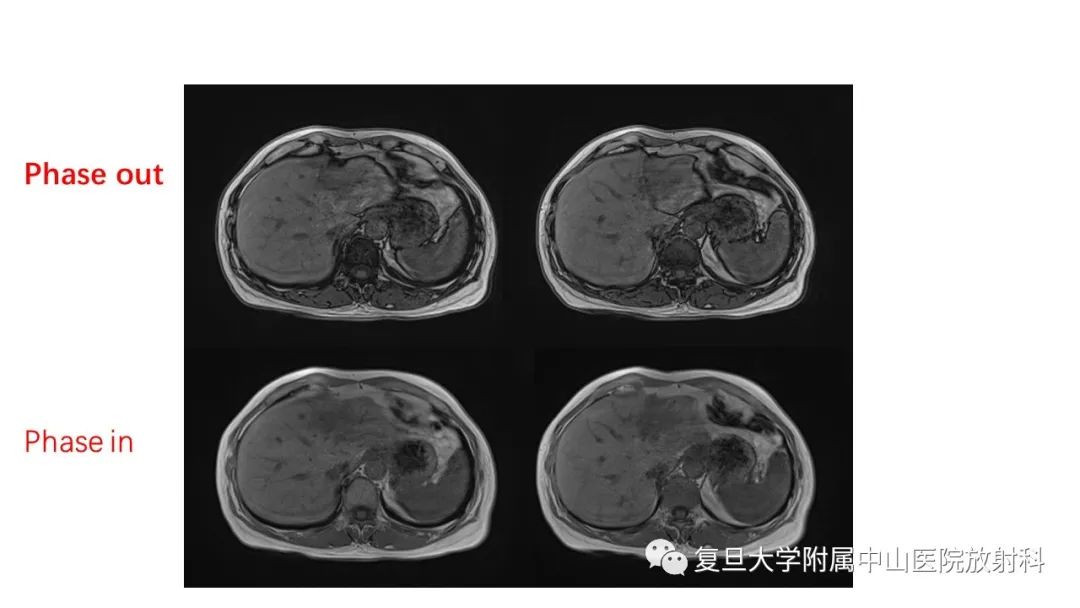 影像PPT - 【病例】肝节段性萎缩1例CT及MR影像-5
