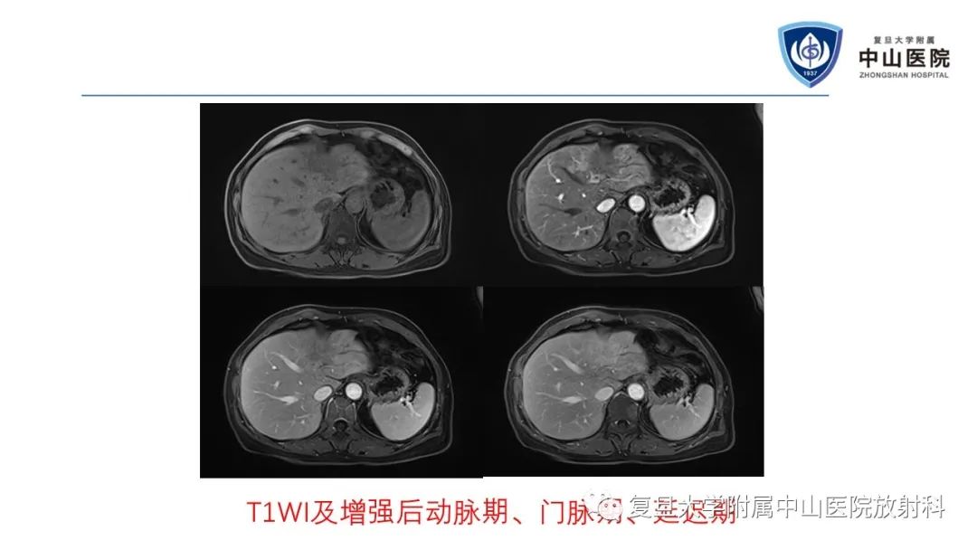 影像PPT - 【病例】肝节段性萎缩1例CT及MR影像-6