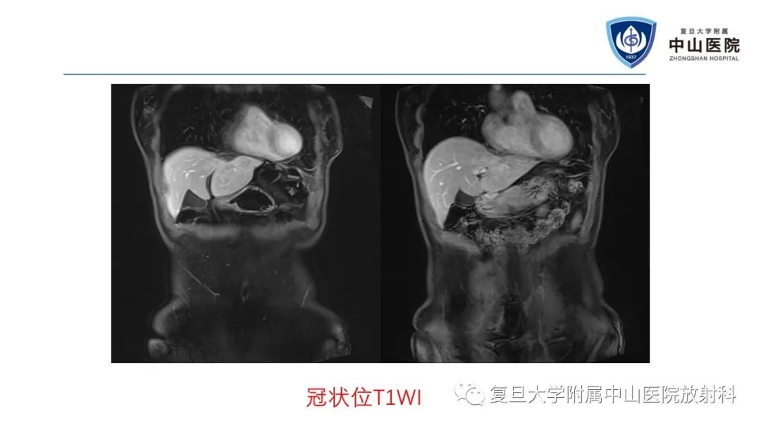 影像PPT - 【病例】肝节段性萎缩1例CT及MR影像-7