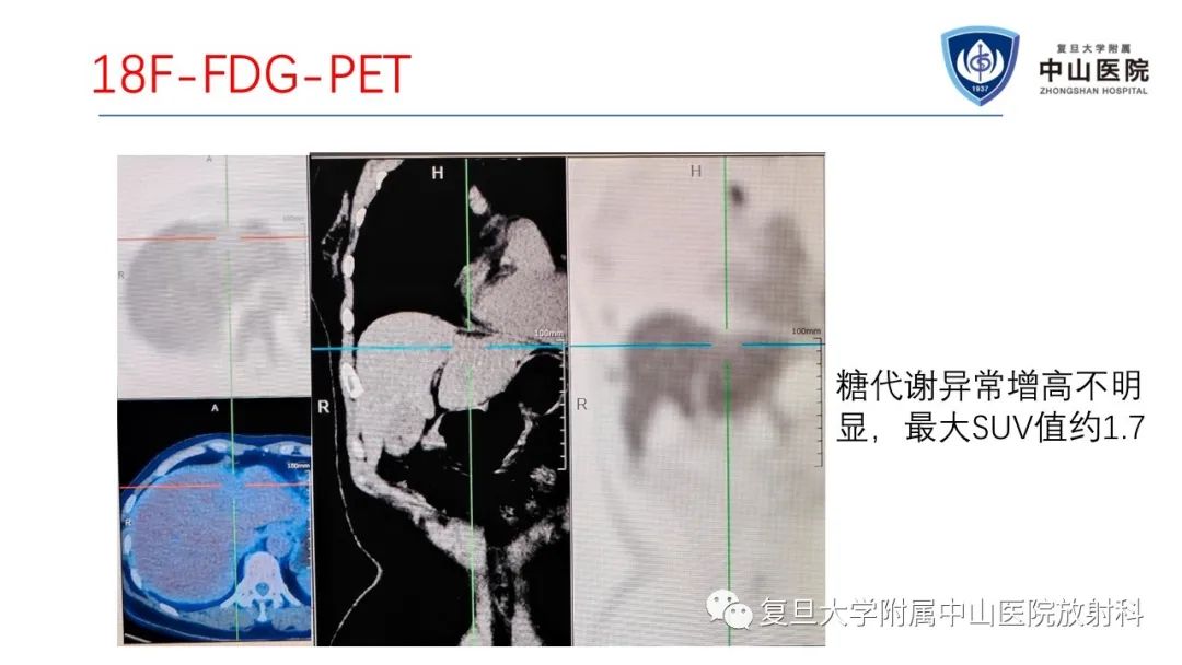 影像PPT - 【病例】肝节段性萎缩1例CT及MR影像-8