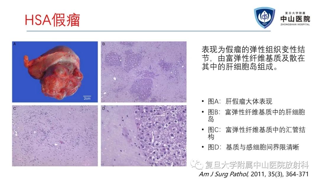 影像PPT - 【病例】肝节段性萎缩1例CT及MR影像-16