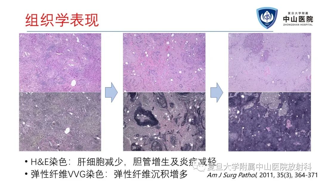 影像PPT - 【病例】肝节段性萎缩1例CT及MR影像-15