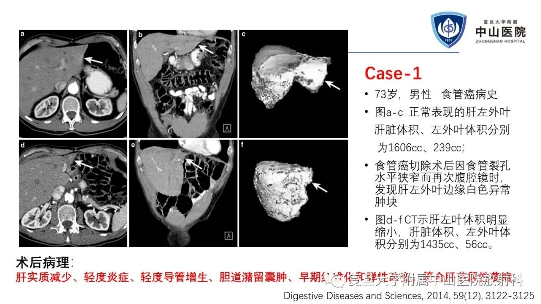 影像PPT - 【病例】肝节段性萎缩1例CT及MR影像-19