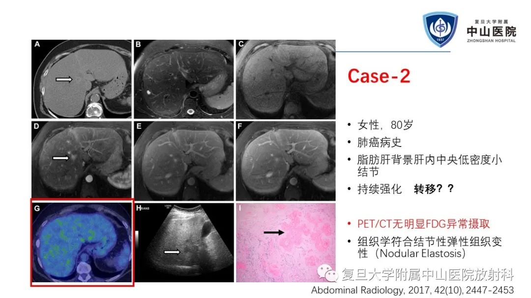 影像PPT - 【病例】肝节段性萎缩1例CT及MR影像-20