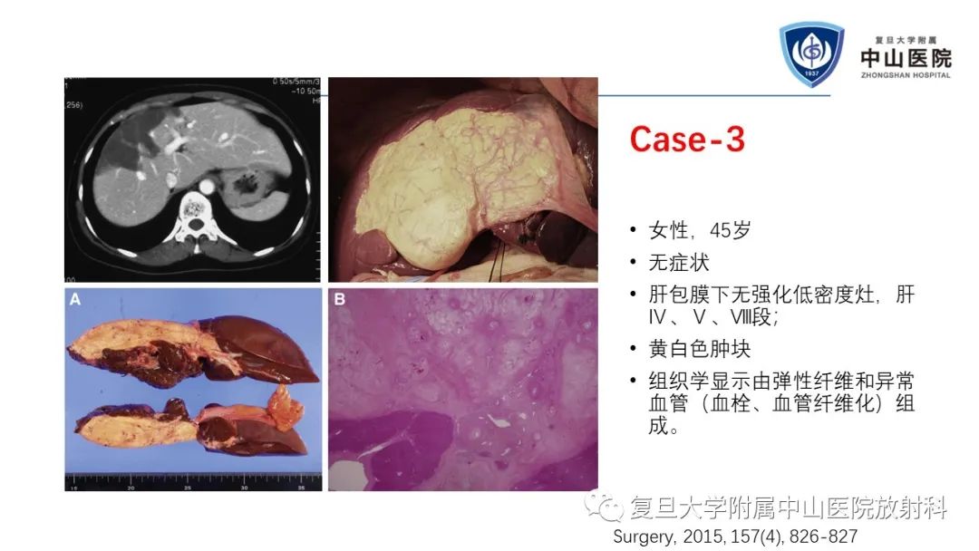 影像PPT - 【病例】肝节段性萎缩1例CT及MR影像-21