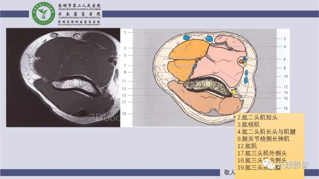 影像PPT - 【PPT】肘关节影像学解剖-7