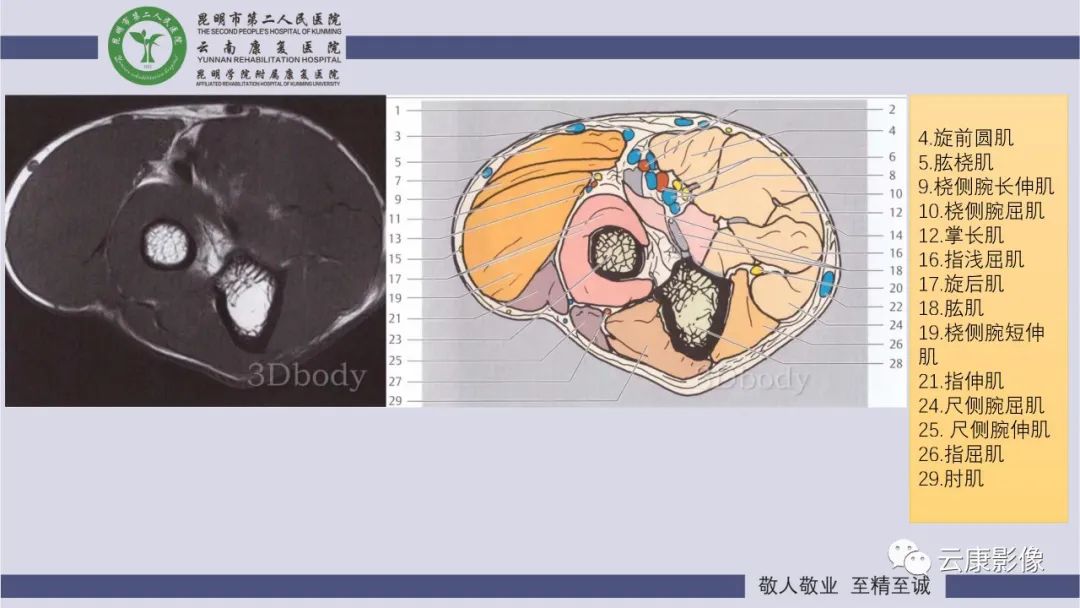 影像PPT - 【PPT】肘关节影像学解剖-11