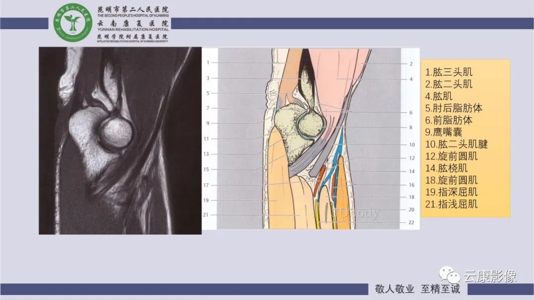 影像PPT - 【PPT】肘关节影像学解剖-14