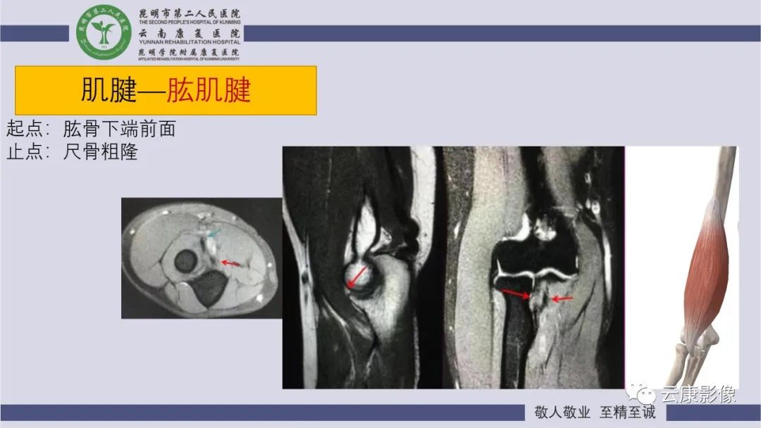 影像PPT - 【PPT】肘关节影像学解剖-28