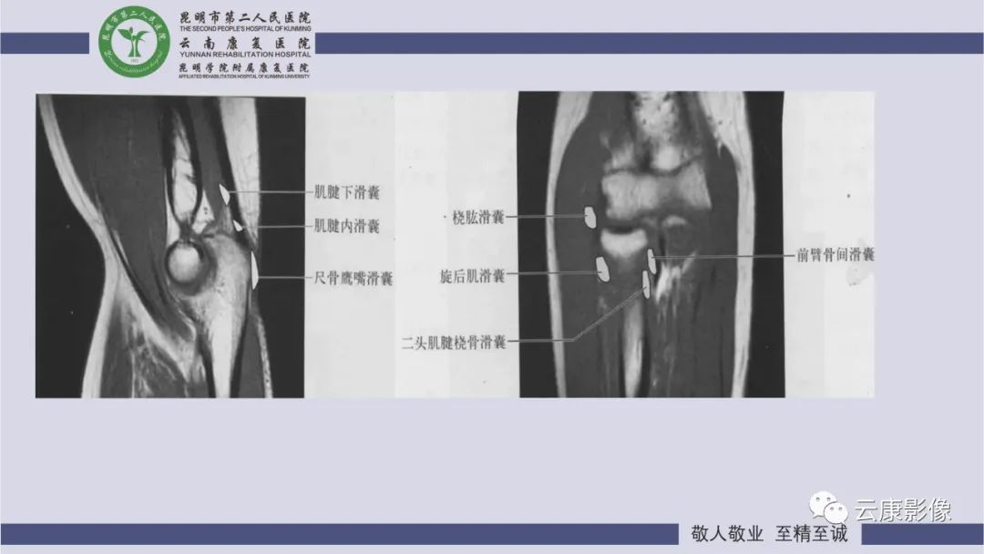 影像PPT - 【PPT】肘关节影像学解剖-32
