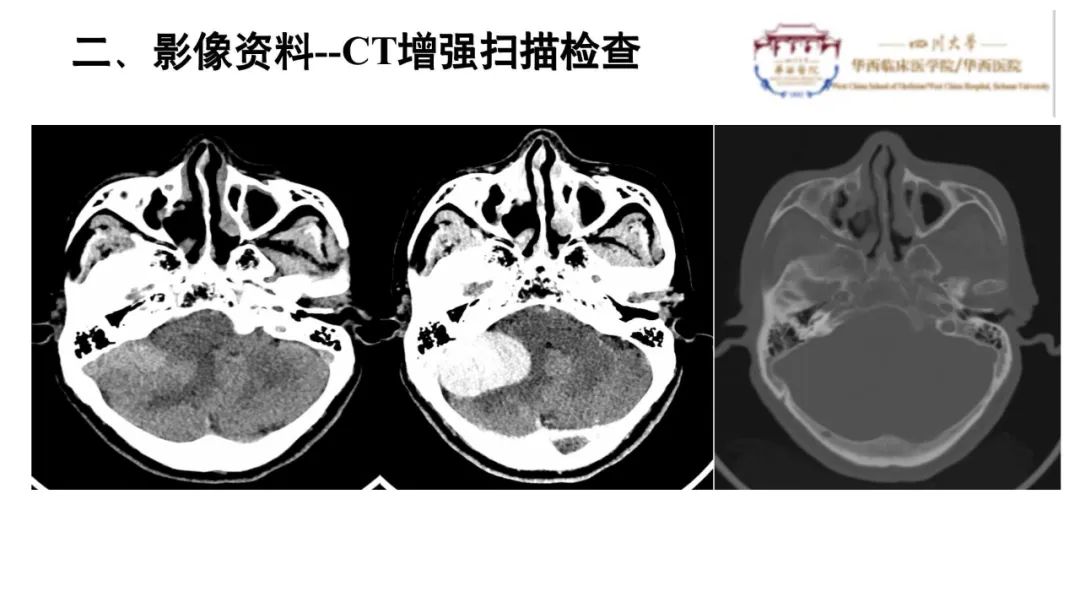 影像PPT - 【病例】颅内血管外皮细胞瘤1例MR影像-3