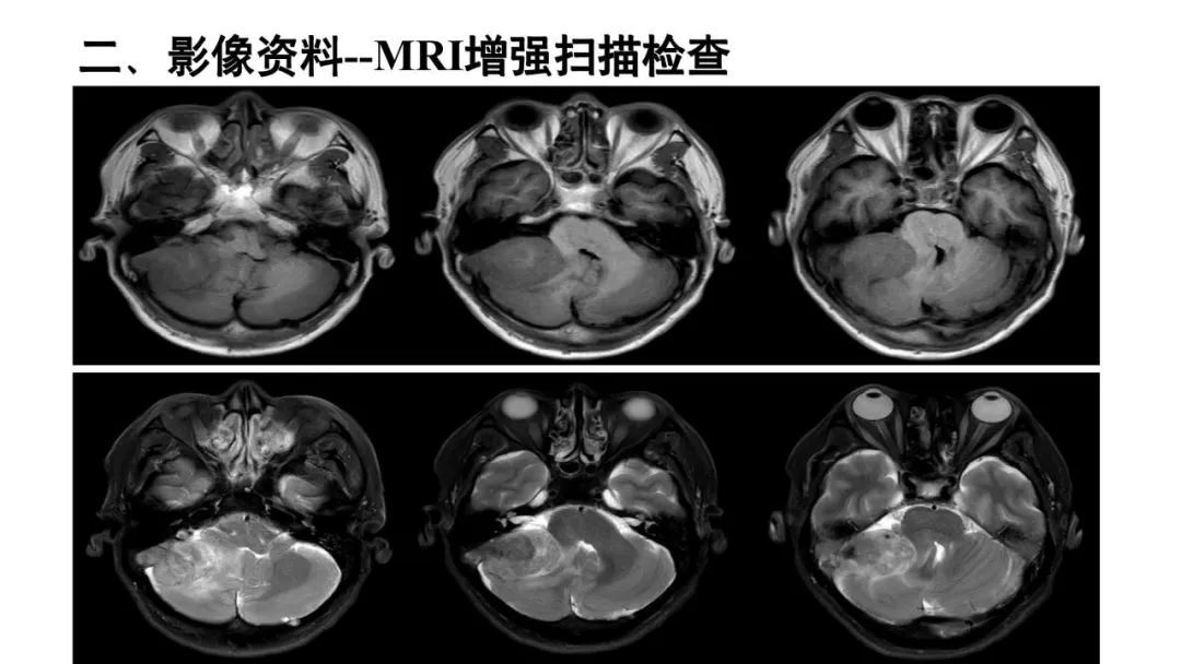 影像PPT - 【病例】颅内血管外皮细胞瘤1例MR影像-4