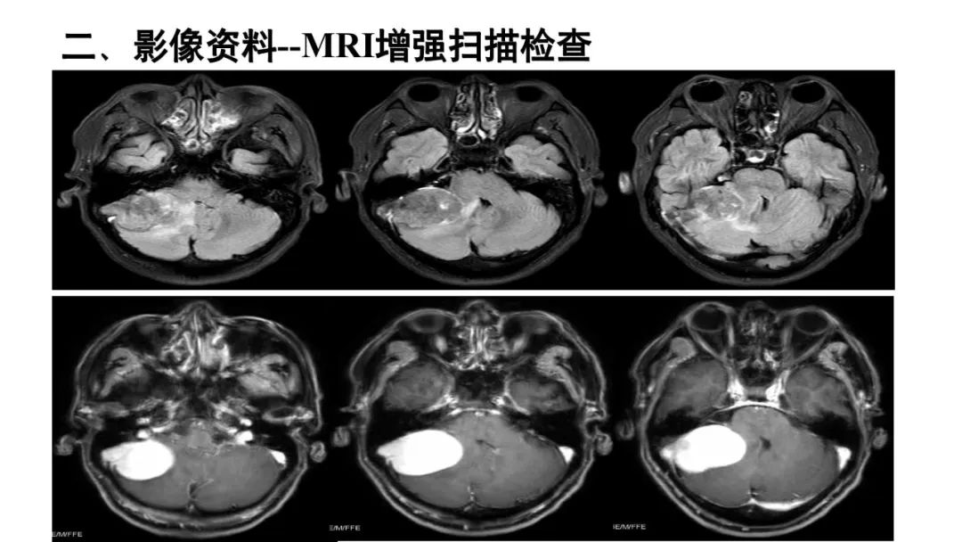 影像PPT - 【病例】颅内血管外皮细胞瘤1例MR影像-5