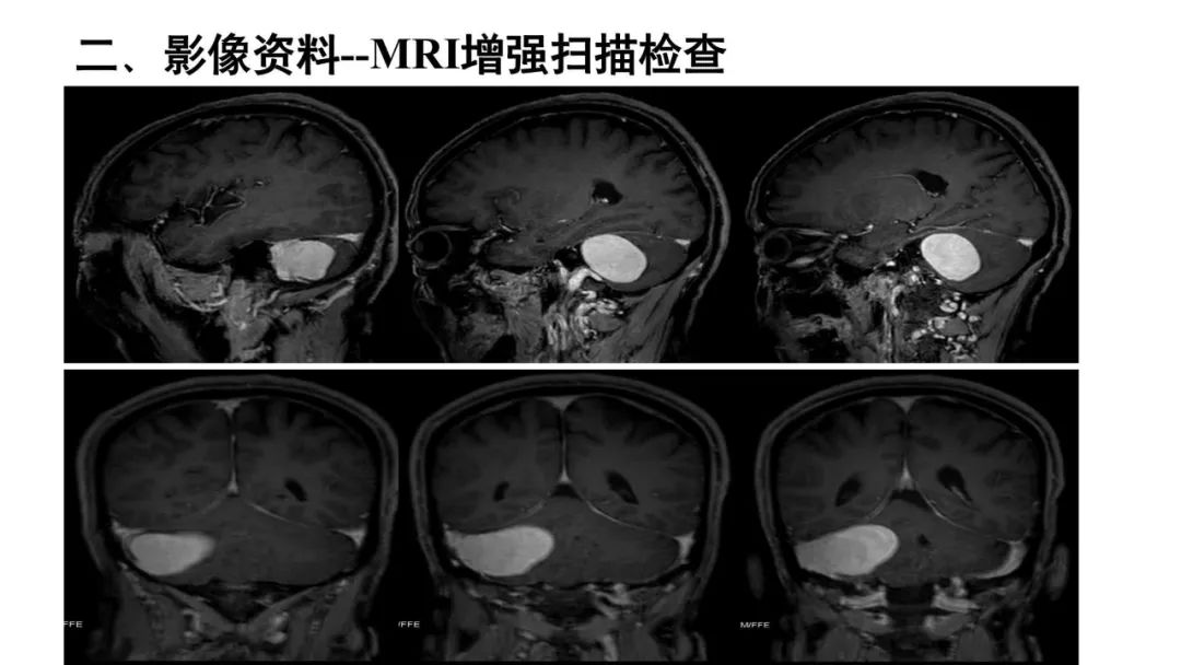 影像PPT - 【病例】颅内血管外皮细胞瘤1例MR影像-6