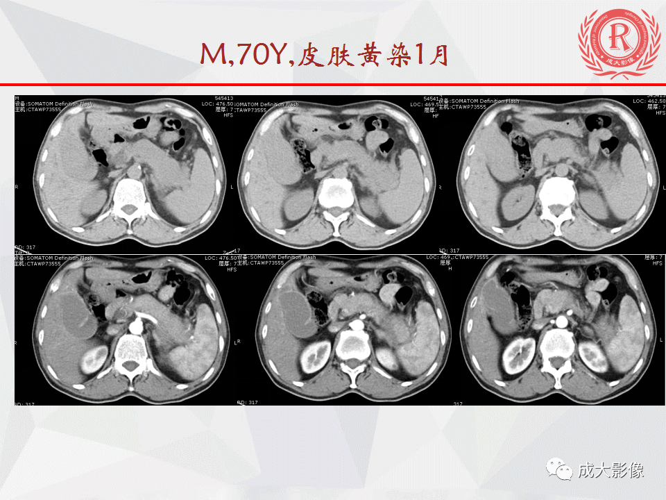 影像PPT - 【PPT】自身免疫性胰腺炎影像诊断-1